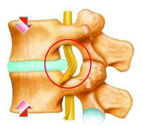 腰椎间盘突出压迫神经腿疼,科学治疗与日常管理指南腰椎间盘突出压迫神经腿疼怎么治效果好